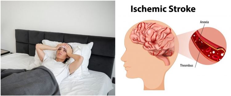 Apa itu stroke iskemik? Kenali gejala, penyebab, dan strategi pencegahannya